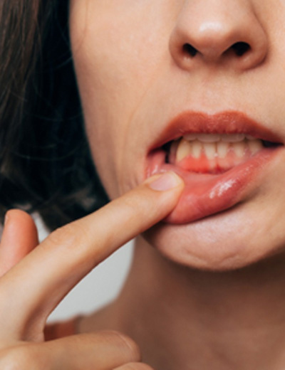 Woman with gum irritation
