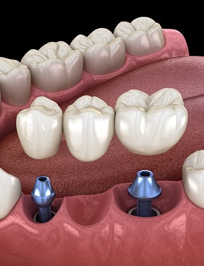 Illustrated dental bridge being placed over two dental implants