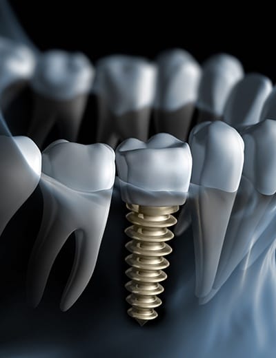 Illustrated x ray of person with a dental implant