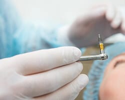 An up close look at a dentist preparing to insert a dental implant into a patient’s mouth