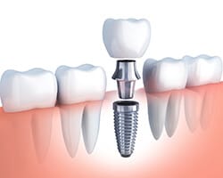 A digital graphic that shows the different parts of a dental implant