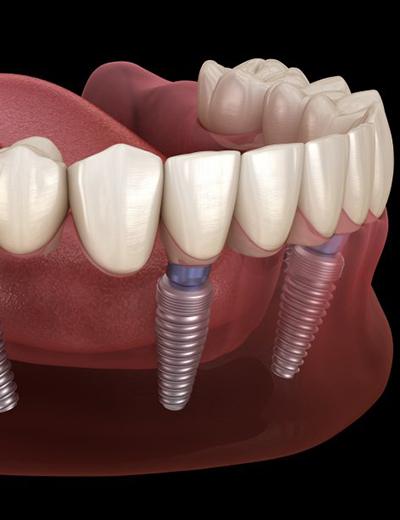 diagram of All-on-4 replacing missing bottom teeth 