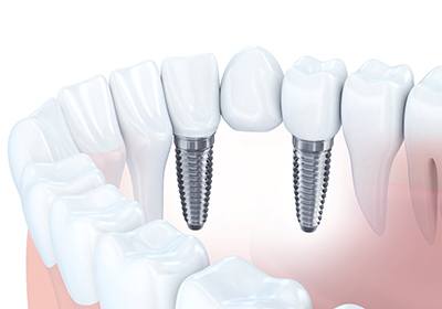 diagram of an implant bridge in North Dallas