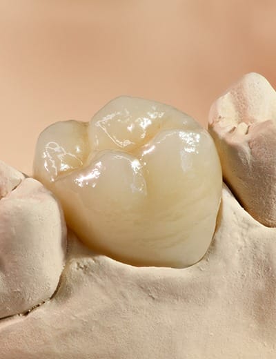 Model of the smile with a dental crown covering one tooth