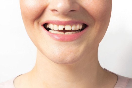 Closeup of a broken tooth