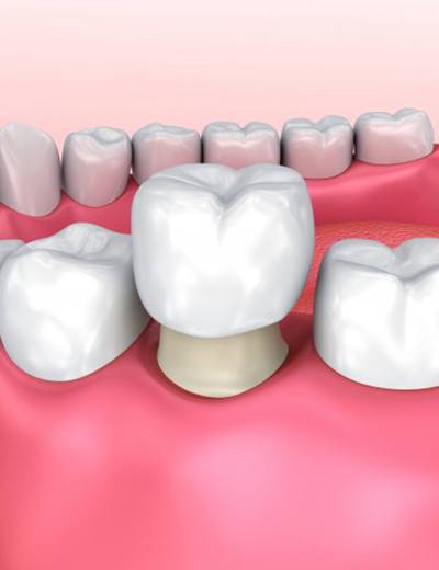 diagram of dental crown being placed over bottom molar 