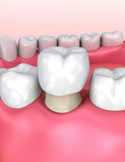 Diagram of dental crown being placed over bottom molar