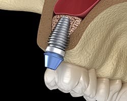 Diagram of sinus lift in North Dallas for dental implants