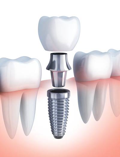 Diagram of a dental implant being placed in lower jaw