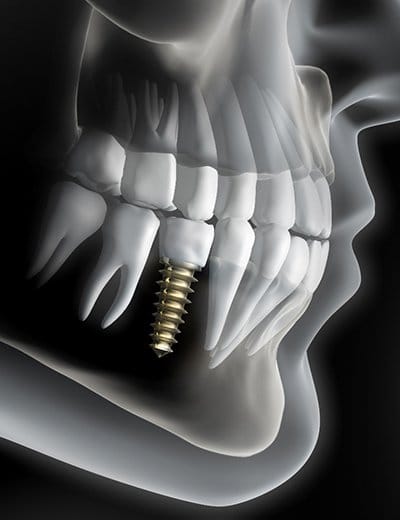 Illustrated x ray of person with one dental implant