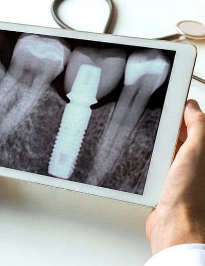 X ray of dental implants in North Dallas