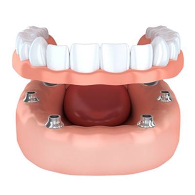Illustration of implant dentures