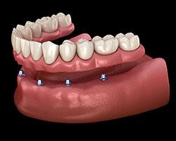 Dentures about to be placed on dental implants