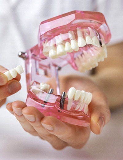 Dentist explaining details of full mouth reconstruction plan
