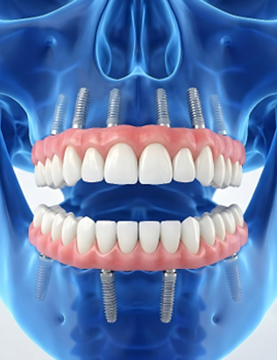 Digital image of implant dentures for upper and lower arches