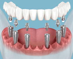 Illustration of fixed implant denture for lower arch