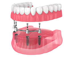 Illustration of bar-retained removable implant denture