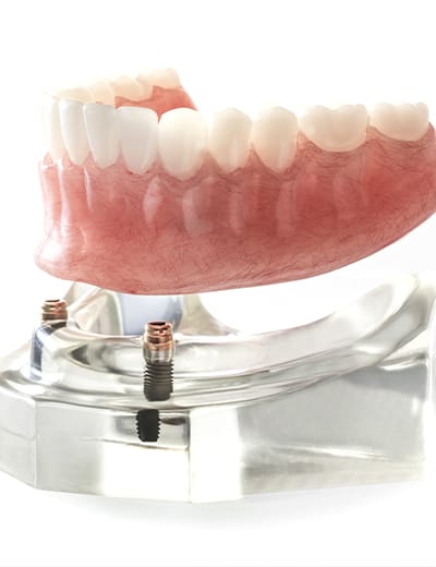 Model of implant denture