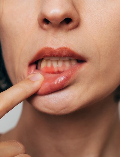 Woman with gum irritation