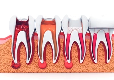 Illustration of the stages of root canal treatment in North Dallas