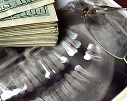 Patient in Dallas’s X-ray  showing need for a root canal