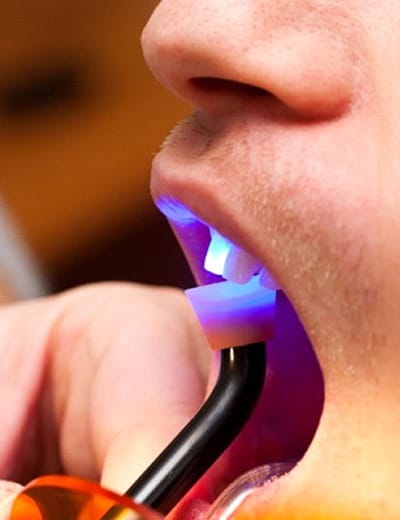 curing light being used