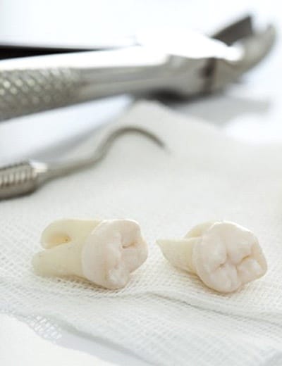 extracted teeth on piece of gauze