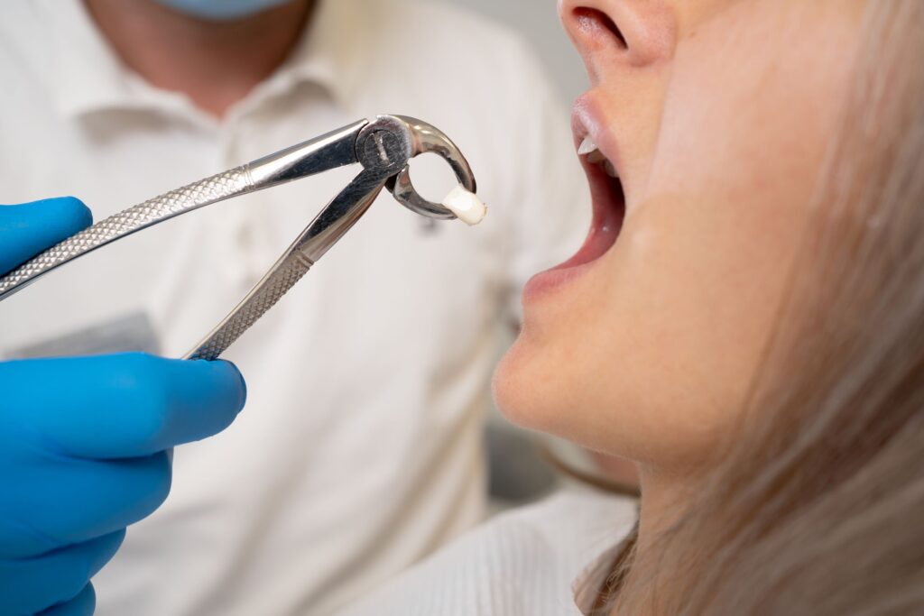 Profile view of woman's open mouth with dentist pulling out extracted tooth